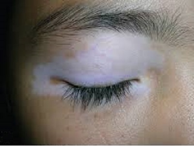Vitiligo around the eyes