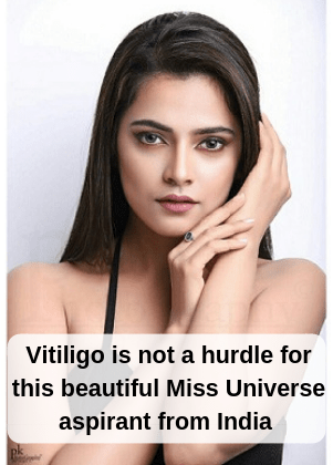 Vitiligo doesn't stop this beautiful Miss Universe aspirant model from India